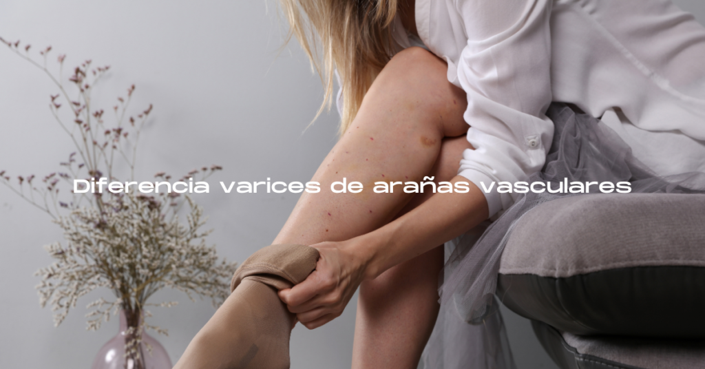 Diferencia varices de arañas vasculares