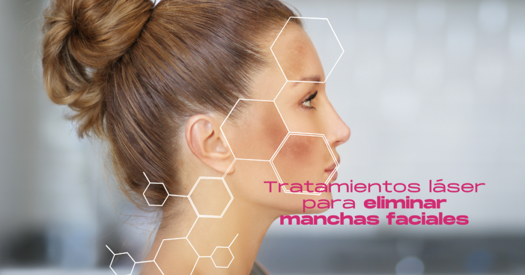 Tratamientos láser para eliminar manchas faciales